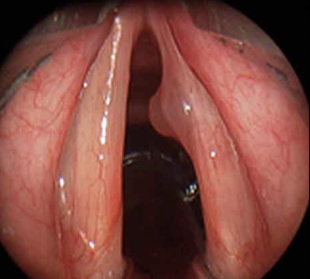 Examens du nez de la gorge et des cordes vocales - ORL NICE